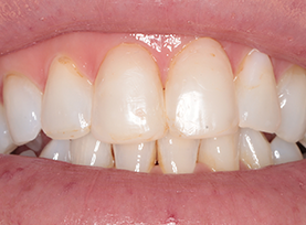 Before Treatment